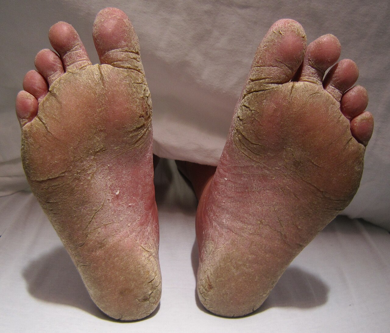 Close-up image illustrating a fungal skin problem affecting the feet